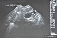 poliquistosis-renal-autosomica-dominante-rinon-poliquistico-bil-ecografia-rn2m-urograia-cistografia-gamagrafia-10-1992-003