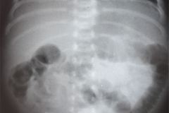 poliquistosis-renal-autosomica-dominante-rinon-poliquistico-bil-ecografia-rn2m-urograia-cistografia-gamagrafia-10-1992-007