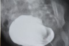 poliquistosis-renal-autosomica-dominante-rinon-poliquistico-bil-ecografia-rn2m-urograia-cistografia-gamagrafia-10-1992-008