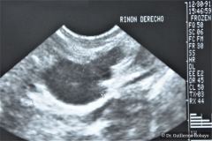 poliquistosis-renal-autosomica-dominante-rinon-poliquistico-bil-ecografia-rn2m-urograia-cistografia-gamagrafia-10-1992-014