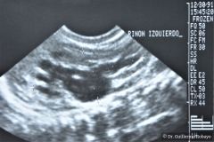 poliquistosis-renal-autosomica-dominante-rinon-poliquistico-bil-ecografia-rn2m-urograia-cistografia-gamagrafia-10-1992-015