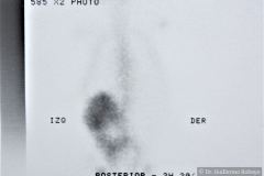 poliquistosis-renal-autosomica-dominante-rinon-poliquistico-bil-ecografia-rn2m-urograia-cistografia-gamagrafia-10-1992-016