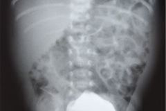 poliquistosis-renal-autosomica-dominante-rinon-poliquistico-bil-ecografia-rn2m-urograia-cistografia-gamagrafia-10-1992-018