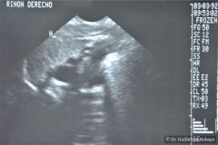 poliquistosis-renal-autosomica-dominante-rinon-poliquistico-bil-ecografia-rn2m-urograia-cistografia-gamagrafia-10-1992-023