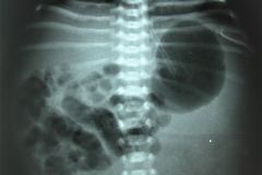 poliquistosis-renal-autosomica-dominante-rinon-poliquistico-izq-1996-001