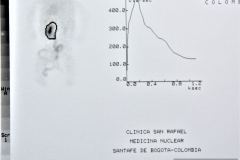 poliquistosis-renal-autosomica-recesiva-rinon-multiquistico-der-ecografia-rn-renograma-6m-1995-000