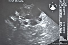 poliquistosis-renal-autosomica-recesiva-rinon-multiquistico-der-ecografia-rn-renograma-6m-1995-001
