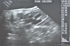 poliquistosis-renal-rinon-poliquistici-izq-ecografia-000