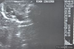 poliquistosis-renal-rinon-poliquistici-izq-ecografia-001