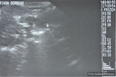 poliquistosis-renal-rinon-poliquistici-izq-ecografia-002