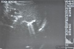 poliquistosis-renal-rinon-poliquistici-izq-ecografia-003