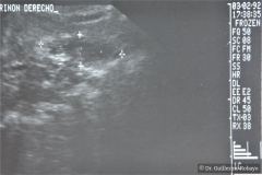 poliquistosis-renal-rinon-poliquistici-izq-ecografia-004