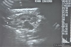 poliquistosis-renal-rinon-poliquistici-izq-ecografia-005