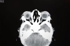 poliquistosis-renal-rinon-poliquistico-bil-ecografia-tac-mielomeningocele-hidrocefalia-1996-008
