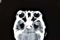 poliquistosis-renal-rinon-poliquistico-bil-ecografia-tac-mielomeningocele-hidrocefalia-1996-009