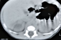 poliquistosis-renal-rinon-poliquistico-bil-ecografia-tac-mielomeningocele-hidrocefalia-1996-013