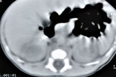 poliquistosis-renal-rinon-poliquistico-bil-ecografia-tac-mielomeningocele-hidrocefalia-1996-014