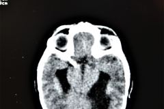 poliquistosis-renal-rinon-poliquistico-bil-ecografia-tac-mielomeningocele-hidrocefalia-1996-015