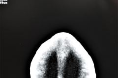 poliquistosis-renal-rinon-poliquistico-bil-ecografia-tac-mielomeningocele-hidrocefalia-1996-016