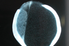 porencefalia-esquizencefalia-2006-028