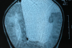 porencefalia-esquizencefalia-2006-030