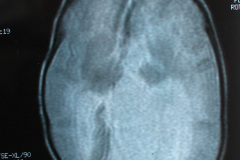 porencefalia-esquizencefalia-2006-046
