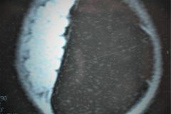 porencefalia-holoprosencefalia-tac-rnm-2006-018