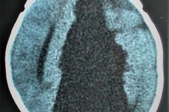 porencefalia-holoprosencefalia-tac-rnm-2006-019