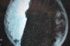 porencefalia-holoprosencefalia-tac-rnm-2006-020