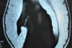 porencefalia-holoprosencefalia-tac-rnm-2006-023