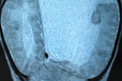 porencefalia-holoprosencefalia-tac-rnm-2006-024