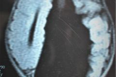 porencefalia-holoprosencefalia-tac-rnm-2006-030