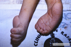 potter-arteria-umbilical-unica-ano-imperforado-fistula-recto-perineal-000