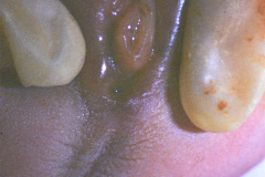 potter-arteria-umbilical-unica-ano-imperforado-fistula-recto-perineal-001