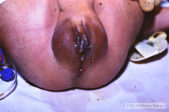 potter-arteria-umbilical-unica-ano-imperforado-fistula-recto-perineal-002