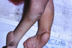 potter-arteria-umbilical-unica-ano-imperforado-fistula-recto-perineal-003