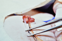 potter-arteria-umbilical-unica-ano-imperforado-fistula-recto-perineal-004