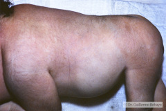 potter-arteria-umbilical-unica-ano-imperforado-fistula-recto-perineal-006
