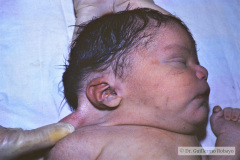 potter-arteria-umbilical-unica-ano-imperforado-fistula-recto-perineal-007