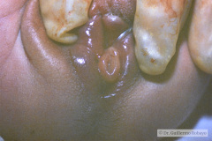 potter-arteria-umbilical-unica-ano-imperforado-fistula-recto-perineal-008