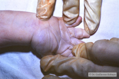 potter-arteria-umbilical-unica-ano-imperforado-fistula-recto-perineal-009