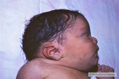 potter-arteria-umbilical-unica-ano-imperforado-fistula-recto-perineal-011