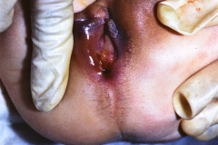 potter-arteria-umbilical-unica-ano-imperforado-fistula-recto-perineal-013