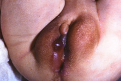 potter-arteria-umbilical-unica-ano-imperforado-fistula-recto-perineal-014