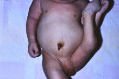 potter-arteria-umbilical-unica-ano-imperforado-fistula-recto-perineal-015