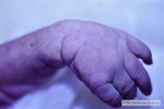 potter-microtia-agenesia-cae-pie-mecedora-1990-003