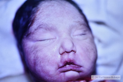 potter-microtia-agenesia-cae-pie-mecedora-1990-005