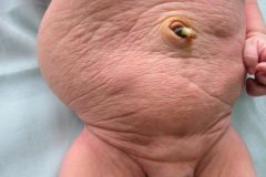prune-belly-eagle-barrett-triada-ciruela-pasa-hipoplasia-musc-abd-hidroureteronefrosis-criptorquidia-2004-003