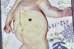 prune-belly-eagle-barrett-triada-ciruela-pasa-postop-pielostomia-bil-agenesia-pene-equino-varo-1994-008