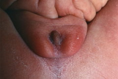 prune-belly-eagle-barrett-triada-ciruela-pasa-uraco-persistente-genitales-ambiguos-malformacion-anorectal-005